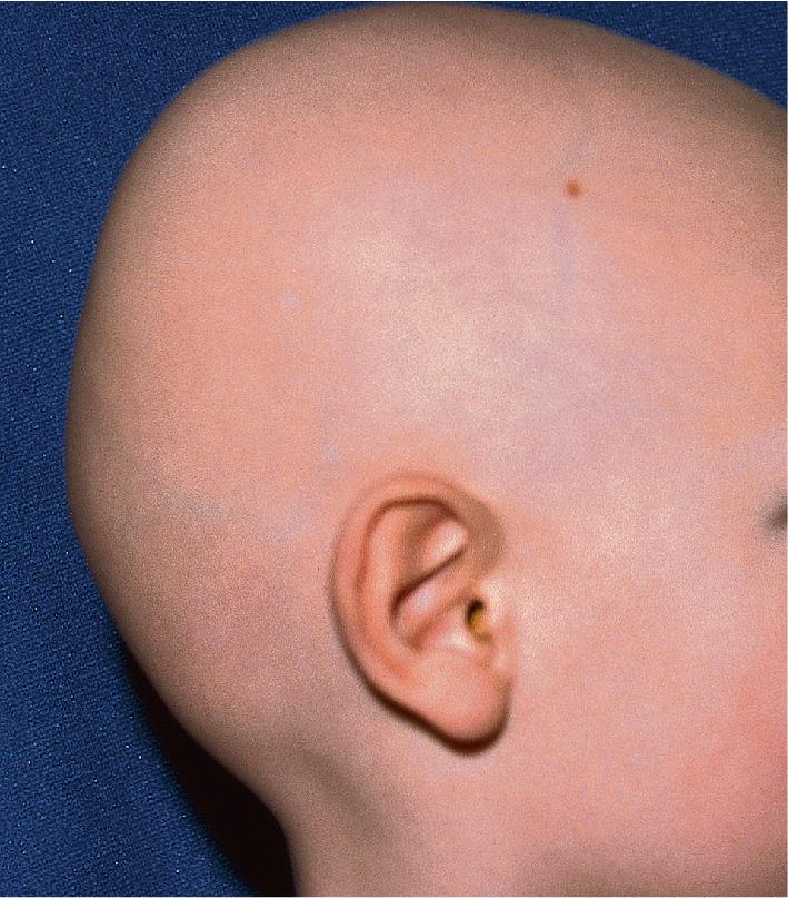 Fig. 7.13, Congenital atrichia. This boy lost his hair during the first year of life and has never regrown it. A mutation in the hairless gene was demonstrated.