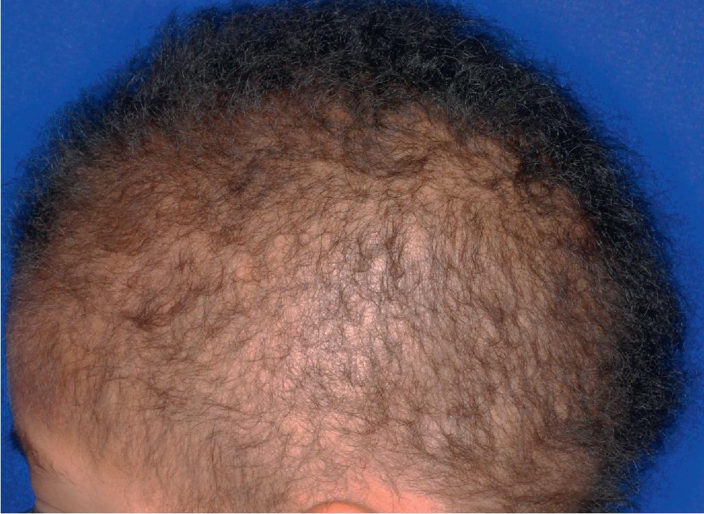 Fig. 7.14, Hypotrichosis simplex. This girl with localized autosomal recessive hypotrichosis began to lose hair in the first months of life and was found to have homozygous variants in C3ORF52 . She had no other medical issues.