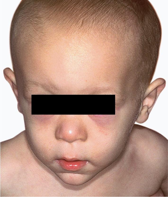 Fig. 7.15, Trichorhinophalangeal syndrome, type I. This 9-month-old boy shows the distinctive facies, including the pear-shaped nose and elongated philtrum, the thin upper lip, and the receding chin, as well as the sparse hair. He had hip dysplasia as well.