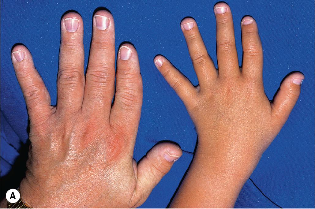 Fig. 7.16, Trichorhinophalangeal syndrome, type I. (A) Brachydactyly in an affected father and daughter with short stature and typical facies. Note the deviation of the middle phalanges. (B) Cone-shaped epiphyses of the second finger of this child’s left and right hands.