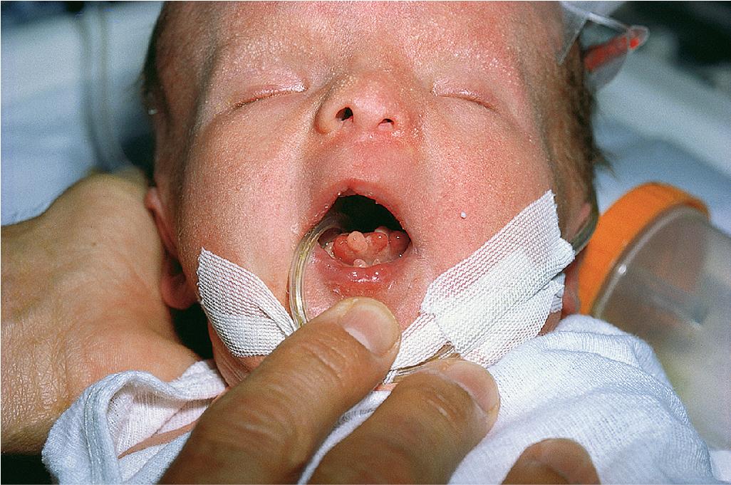 Fig. 7.17, Oral-facial-digital syndrome, type I. This infant girl shows the asymmetric hypoplasia of nasal cartilages and lobulated cleft tongue. Note the many facial milia on the cheek and eyelids. The hair continues to be sparse and dry.