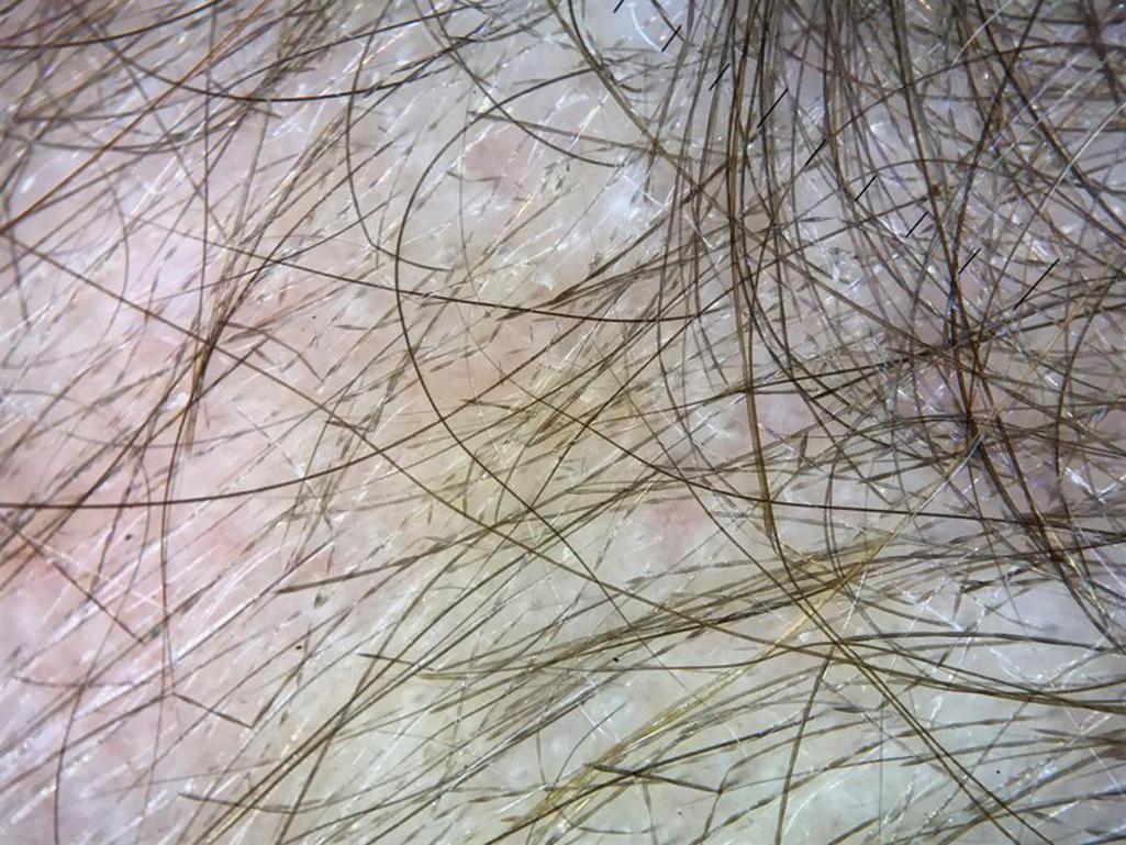 Fig. 7.4, Monilethrix. The distinct beading of monilethrix can be appreciated under trichoscopy (using the dermatoscope).