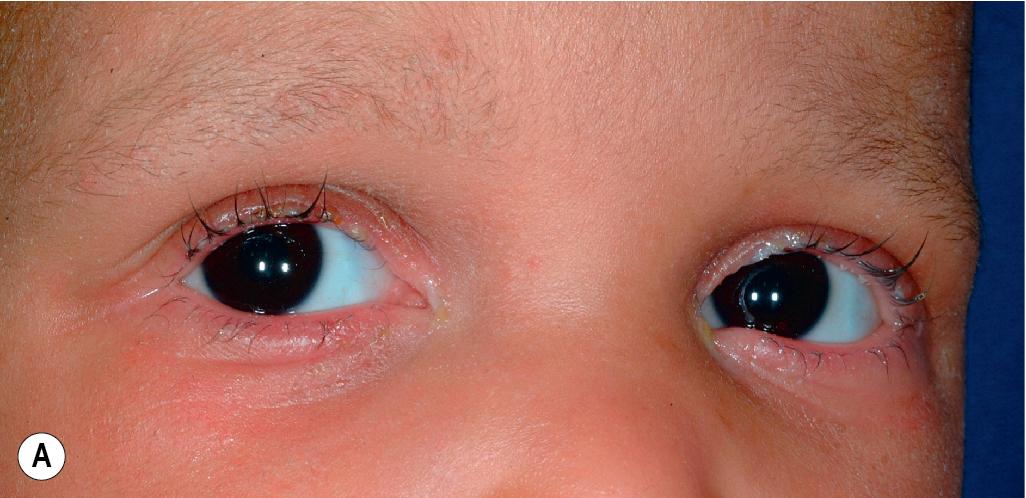 Fig. 7.6, Netherton syndrome. (A) The characteristic microscopic features of Netherton hair (trichorrhexis invaginata) are often found in eyebrow hairs. Note the sparse, broken brows and lashes in this young girl who also shows the periorbital dermatitis. (B) Short, broken hair throughout the scalp. Note the desquamative scaling and excoriations.