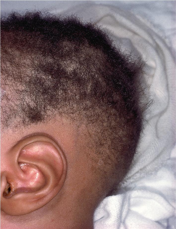 Fig. 7.7, Menkes syndrome. The hair is fine, dull, hypopigmented compared with other family members, and stands on end. It looks and feels like steel wool.