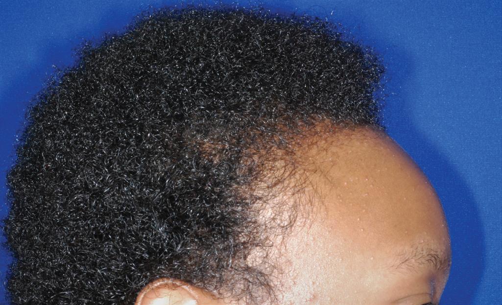 Fig. 7.8, Marie Unna hypotrichosis. Note the loss of hair at the frontal hairline and the sparse, coarse eyebrows. Progressive alopecia will leave him largely alopecic as an adult.