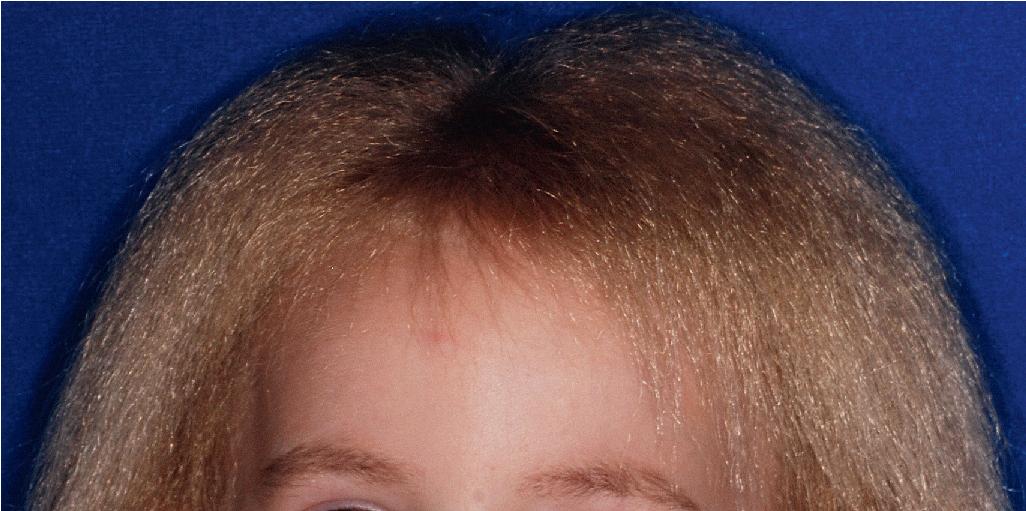 Fig. 7.10, Uncombable hair syndrome. Blond hair that is dry and frizzy and does not lie flat on the scalp, thus making combing impossible.