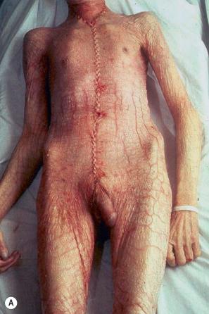 Fig. 3.1, ( A , B ) Severe generalized ichthyosis: this was an incidental finding at autopsy. Ichthyosis can be very disfiguring and a considerable social disadvantage.