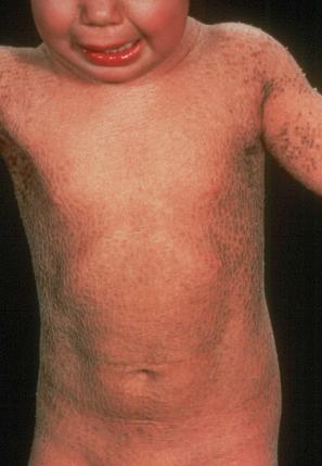 Fig. 3.11, Autosomal recessive lamellar ichthyosis: note the widespread and prominent large dark brown scales.