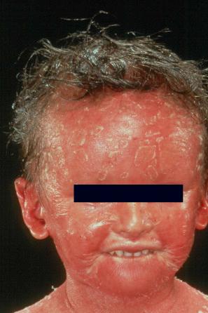 Fig. 3.13, Autosomal recessive congenital ichthyosis: there is intense erythema and fine scaling is also present. The scalp hair is sparse and the eyebrows are absent.