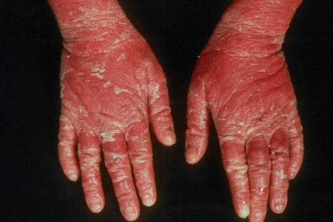 Fig. 3.14, Autosomal recessive congenital ichthyoses: there is marked erythema with severe scaling. Blistering is not seen in this variant of ichthyosis.