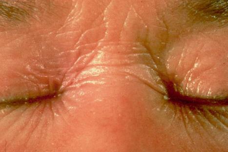 Fig. 3.15, Autosomal recessive congenital ichthyosis: there is intensive erythema and fine scaling.