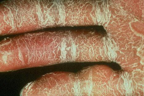 Fig. 3.16, Autosomal recessive congenital ichthyosis: there is severe palmar involvement and constriction bands are evident.