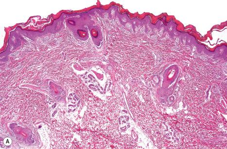 Fig. 3.18, Autosomal recessive congenital ichthyosis: ( A ) there is very marked orthohyperkeratosis and the epidermis shows papillomatosis; ( B ) the stratum granulosum is preserved. Note a mild lymphocytic infiltrate.