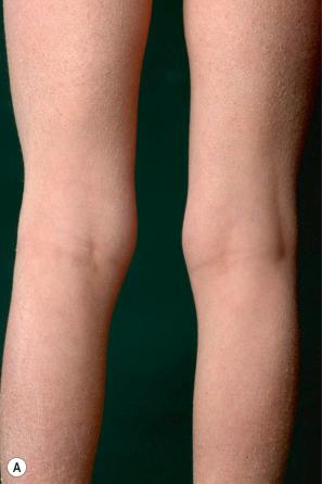 Fig. 3.2, ( A ) Ichthyosis vulgaris: fine scaling, particularly involving the extremities and characteristically sparing the flexures. ( B ) Palms show typically increased skin markings.