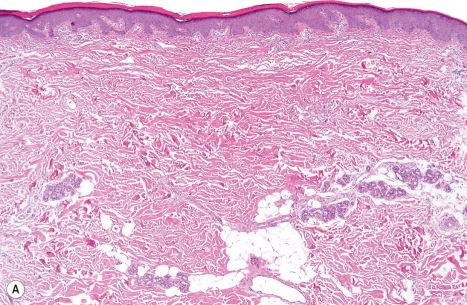 Fig. 3.22, ( A , B ) Autosomal dominant lamellar ichthyosis: there is a marked compact hyperkeratosis with focal parakeratosis and a prominent granular cell layer.