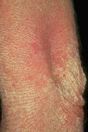 Fig. 3.26, Epidermolytic ichthyosis: same patient as Figure 3.25 , showing elbow involvement with verrucous hyperkeratosis.