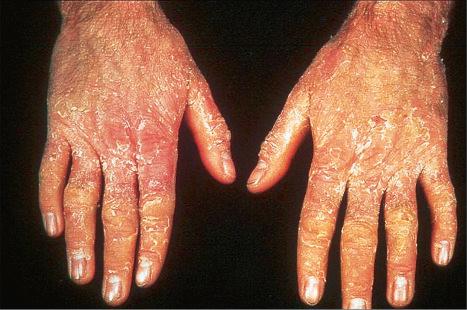 Fig. 3.27, Epidermolytic ichthyosis: the hands are particularly affected.