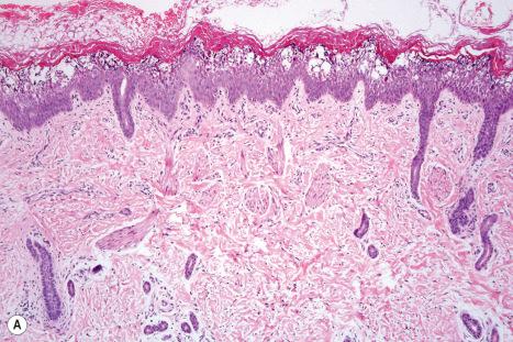 Fig. 3.29, Epidermolytic ichthyosis: ( A ) there is massive hyperkeratosis and acanthosis. The epidermis shows conspicuous superficial vacuolation, which has resulted, in vesiculation; ( B ) there is intracellular vacuolation, and irregular eosinophilic granules (representing dense abnormal aggregates of keratin filaments) are present in the superficial layers of the epidermis.