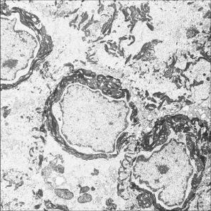 Fig. 3.30, Epidermolytic ichthyosis: striking perinuclear keratin clumping is evident.