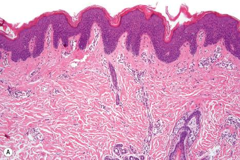 Fig. 3.3, ( A , B ) Ichthyosis vulgaris: there is orthohyperkeratosis with characteristic absence of the granular cell layer.