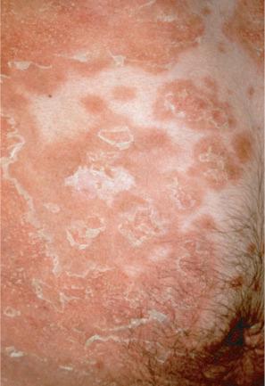 Fig. 3.31, Annular epidermolytic ichthyosis: migrating, polycyclic, gray hyperkeratotic plaques with a peripheral erythematous border.