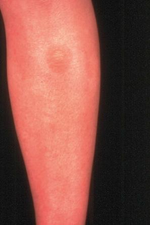 Fig. 3.32, Superficial epidermolytic ichthyosis: flexural hyperkeratosis with early blister formation.