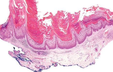 Fig. 3.35, Epidermolytic acanthoma: the lesion is papillomatous with massive hyperkeratosis. There is a superficial perivascular chronic inflammatory cell infiltrate.