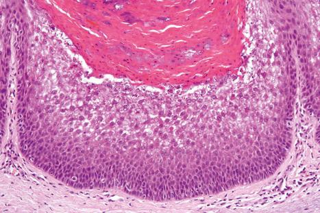 Fig. 3.36, Epidermolytic acanthoma: there is superficial cytoplasmic vacuolation and eosinophilic inclusions are conspicuous.