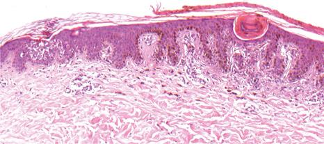 Fig. 3.37, Incidental epidermolytic hyperkeratosis: focal expression of epidermolytic hyperkeratosis in the periphery of a melanocytic nevus.