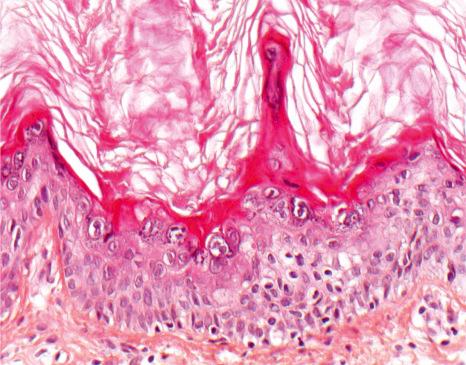 Fig. 3.38, Ichthyosis hystrix Curth-Macklin: the epidermis is acanthotic and orthohyperkeratotic. The suprabasal keratinocytes are vacuolated but lack eosinophilic intracytoplasmic inclusions and some are binucleated.