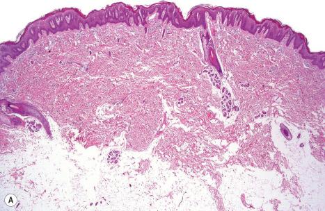 Fig. 3.40, Congenital reticular ichthyosiform erythroderma: ( A ) there is hyperkeratosis and well-developed psoriasiform hyperplasia; ( B ) parakeratosis with prominent nuclei and absence of a granular layer are also observed. Note the cytoplasmic vacuolation and binucleated keratinocytes. Eosinophilic intracytoplasmic inclusions are absent.