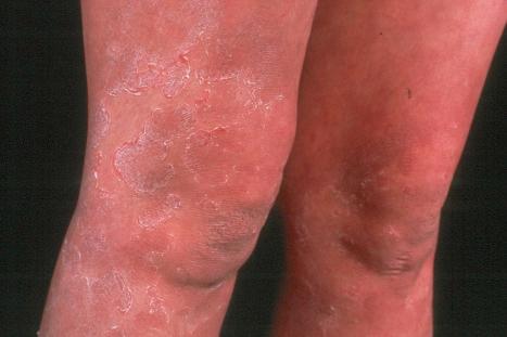 Fig. 3.41, Comèl-Netherton syndrome: ichthyosis linearis circumflexa. Note the serpiginous lesions with characteristic double border.