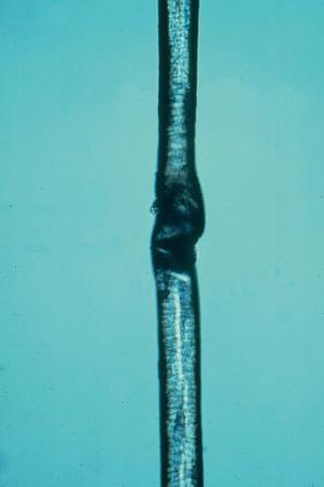 Fig. 3.44, Comèl-Netherton syndrome: bamboo hair (trichorrhexis invaginata).