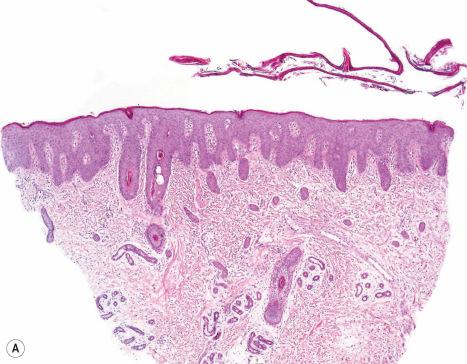 Fig. 3.45, Comèl-Netherton syndrome: ( A ) scanning view showing a detached thickened stratum corneum and psoriasiform hyperplasia; ( B ) note the marked parakeratosis and dilated vessels mimicking psoriasis vulgaris.