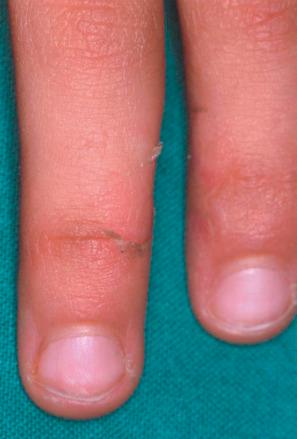 Fig. 3.48, Acral peeling skin syndrome type C: the skin of the backs of hand and feet shows reddish scaly patches.