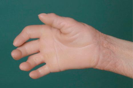 Fig. 3.49, Keratosis linearis-ichthyosis congenita-sclerosing keratoderma (KLICK): diffuse palmoplantar keratoderma and keratotic papules arranged in parallel lines on the wrist.