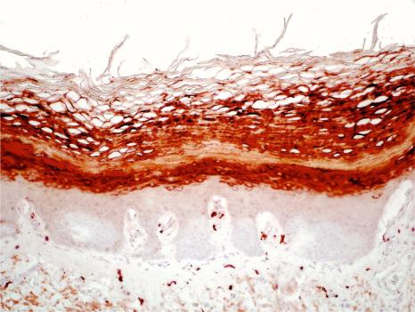 Fig. 3.50, Keratosis linearis-ichthyosis congenita-sclerosing keratoderma (KLICK): immunostaining for filaggrin shows broad immunoreactivity in the upper epidermis that characteristically extends into the horny layer .