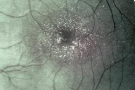 Fig. 3.52, Sjögren-Larsson syndrome: characteristic macular crystals.