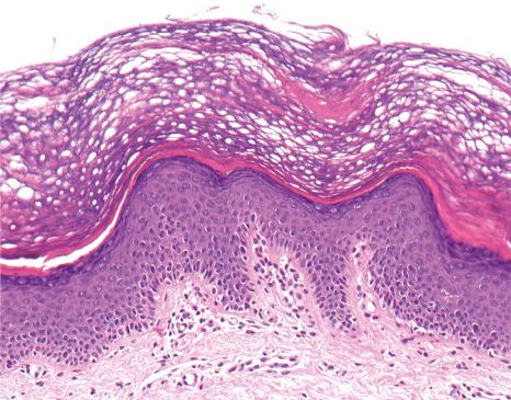 Fig. 3.53, Sjögren-Larsson syndrome: there is hyperkeratosis, with focal parakeratosis, hypergranulosis, and mild papillomatosis. A mild superficial perivascular lymphocytic infiltrate is present.