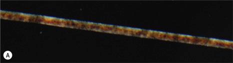 Fig. 3.54, Trichothiodystrophy: ( A ) polarizing microscopy of a hair shows an alternating light and dark banding (‘tiger-tail pattern’). ( B ) The same hair without polarizing.