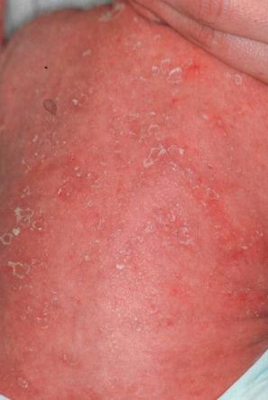 Fig. 3.55, Conradi-Hünermann-Happle syndrome: scaly erythema follows the whorled lines of Blaschko.