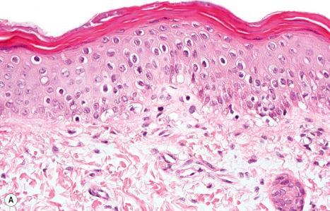 Fig. 3.56, Conradi-Hünermann-Happle syndrome: ( A ) there is hyperkeratosis, acanthosis, and a reduced granular cell layer. Note the basophilic deposits within the thickened stratum corneum; ( B ) the basophilic deposits represent calcium as seen in this von Kossa preparation.