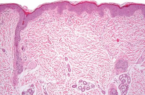 Fig. 3.58, Ichthyosis follicularis with alopecia and photophobia: The hair follicle is atrophic and lacks a hair shaft; the opening contains a keratotic plug.