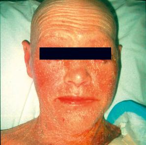 Fig. 3.61, Acquired ichthyosis: there is intense erythema and scaling. This patient also suffered from graft-versus-host disease.