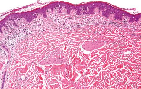 Fig. 3.62, Acquired ichthyosis: this patient developed ichthyosis in a background of mycosis fungoides. Low-power view showing marked focally compact hyperkeratosis and acanthosis.