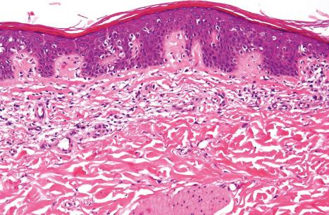 Fig. 3.63, Acquired ichthyosis: high-power view to emphasize the thinned granular layer. Mycosis fungoides as defined by an atypical lymphocyte population and epidermotropism with retraction artifact.