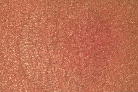 Fig. 3.64, Pityriasis rotunda: characteristic lesion showing circumscription, scaling, and hyperpigmentation.