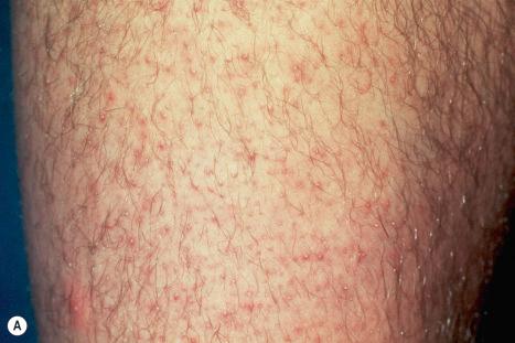 Fig. 3.65, Keratosis pilaris: ( A ) typical follicular papules and pustules on the thigh; ( B ) note the conspicuous plugged follicles. ( A ) By courtesy of R.A. Marsden, MD, St George's Hospital, London, UK. ( B ) By courtesy of the Institute of Dermatology, London, UK.