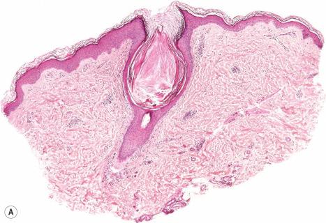 Fig. 3.66, Keratosis pilaris: ( A ) there is follicular dilatation and plugging; ( B ) note the atrophy of the infundibular epithelium.