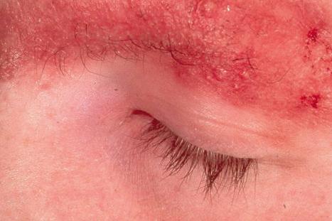 Fig. 3.67, Ulerythema ophryogenes: there is intense erythema with loss of follicles. The eyebrow is a commonly affected site.